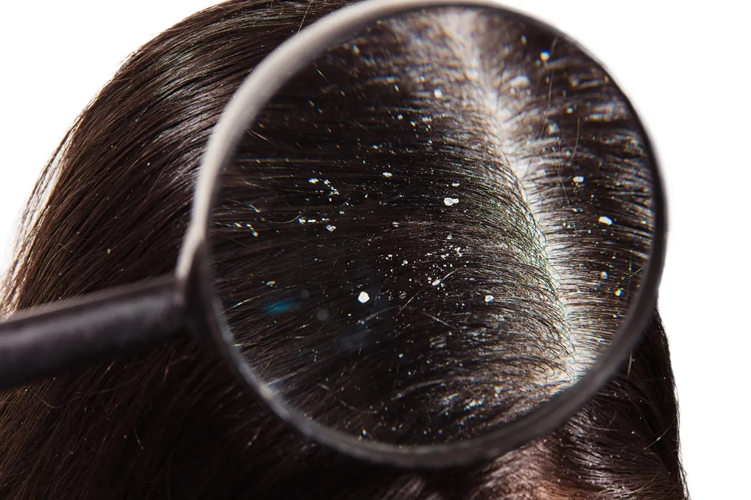 dandruff can be exacerbated by factors such as poor nutrition, stress