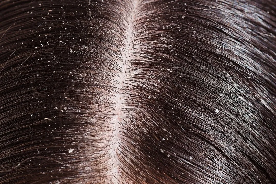 Anti-dandruff shampoos are manufactured with specific ingredients