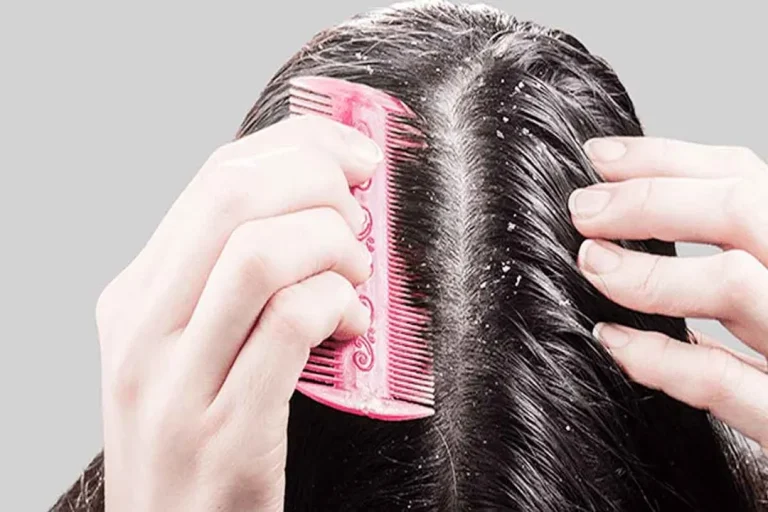 Choosing an Anti-Dandruff Shampoo