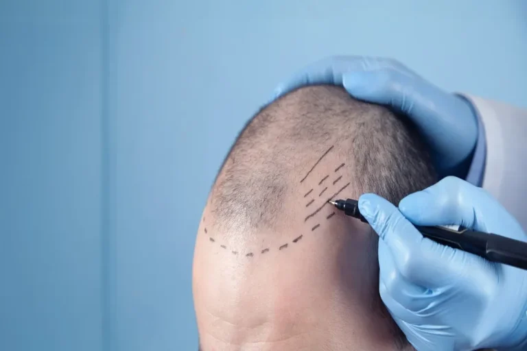 Strengthening shampoo after hair transplantation, the necessity of choosing and using