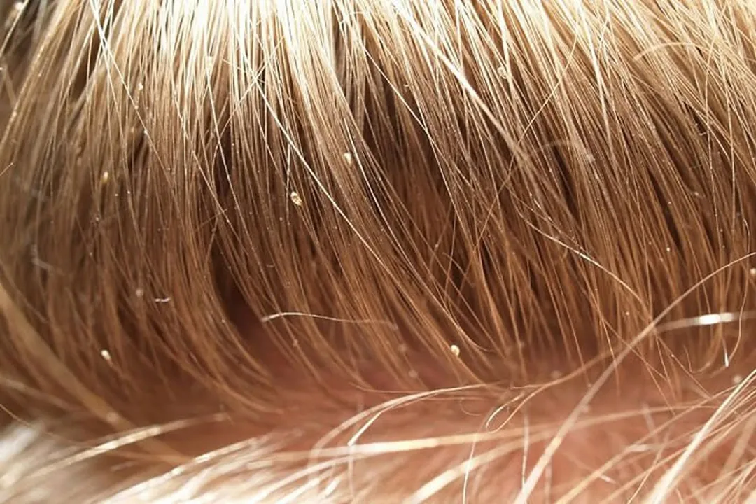 Head lice are a common health problem that is often seen in school children